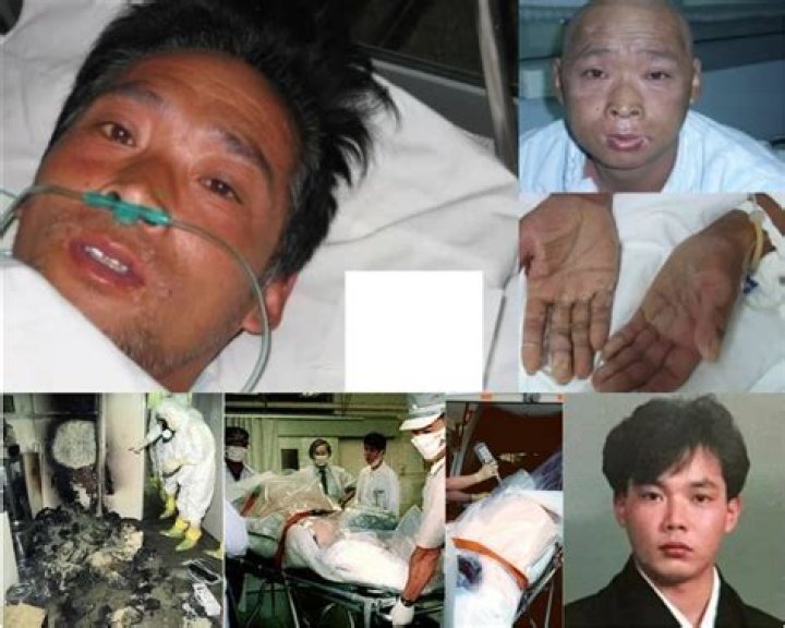 Hisashi Ouchi Real Photos, Suffered 83 Days Of Death From Radiation Poisoning