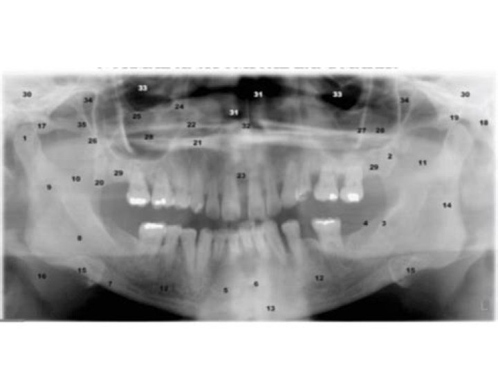 Panoramic Radiograph Normal Anatomical Landmarks Quiz