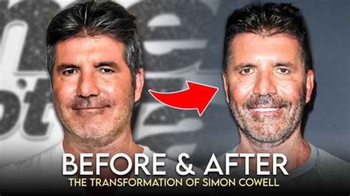 Simon Cowell Before And After Pictures What